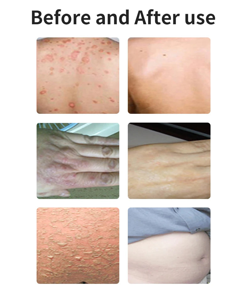 Home Use Psoriasis Equipment 308nm UV Lamps Phototherapy Medical Device UvbTreatment Light For Vitiligo