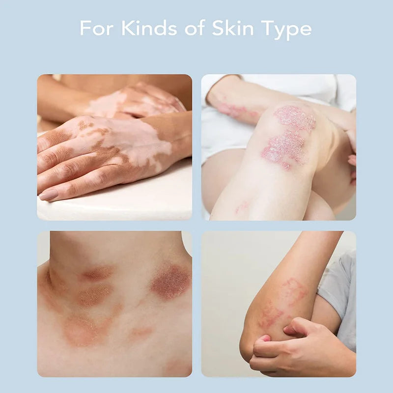 uvb 311nm lamp Psoriasis Vitiligo White Spots Skin Disease Therapy Lamp 311nm Ultraviolet Phototherapy Instrument use UVB  Lamp