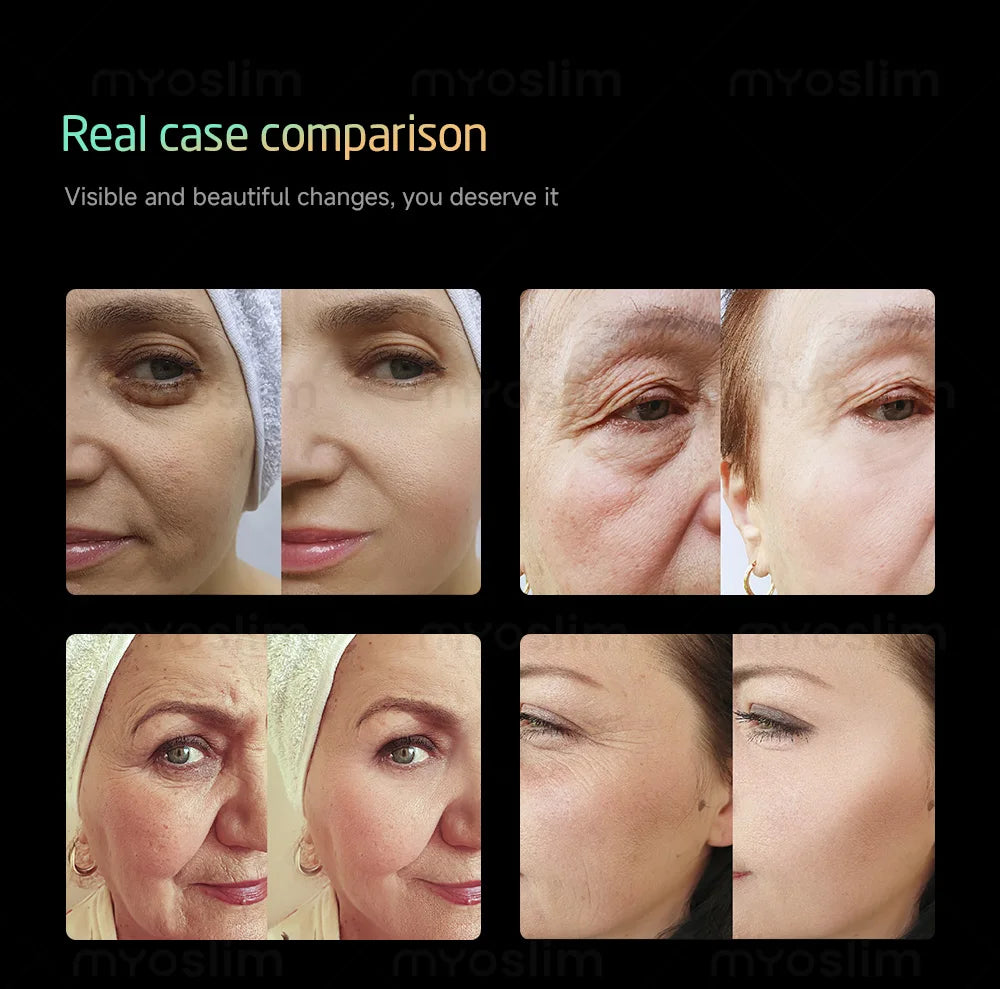Portable 25D 360 Max Rf Lift Facial Lift Body Lift Skin Firming Anti-aging Skin Rejuvenation Firming Machine Salon.