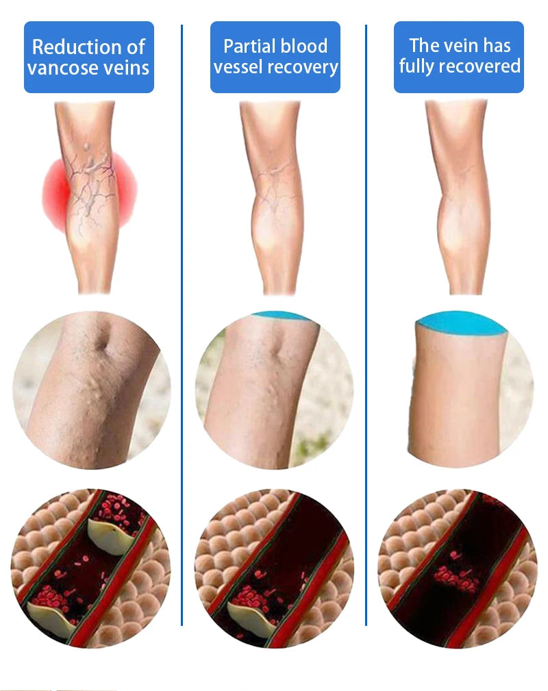 2026 Best-Selling Blue Light Leg Vein Repair Device – Restoring Leg Health