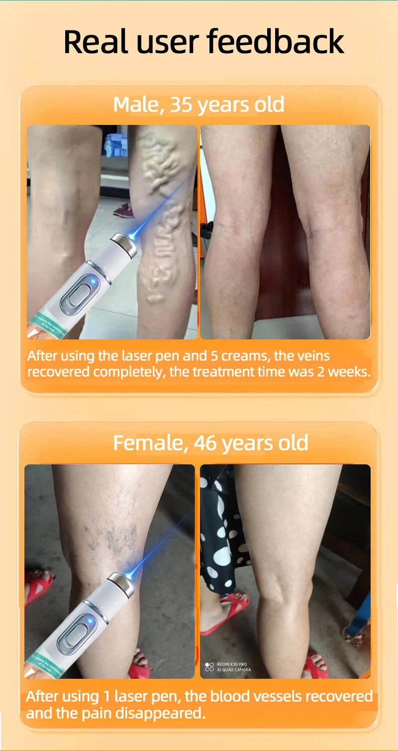 2026 Best-Selling Blue Light Leg Vein Repair Device – Restoring Leg Health