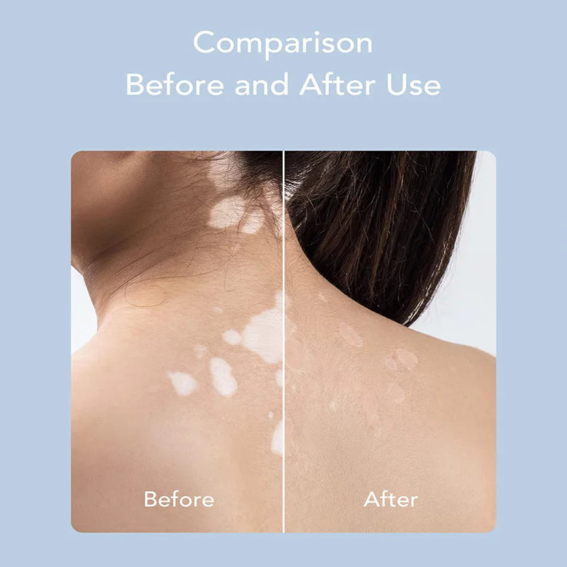 uvb 311nm lamp Psoriasis Vitiligo White Spots Skin Disease Therapy Lamp 311nm Ultraviolet Phototherapy Instrument use UVB  Lamp