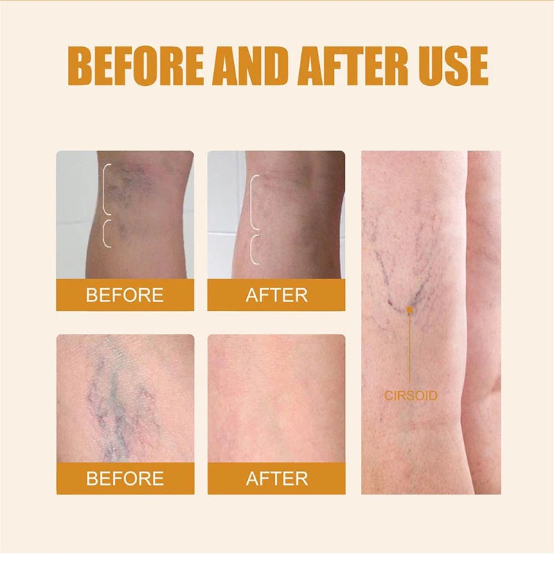 2026 Best-Selling Blue Light Leg Vein Repair Device – Restoring Leg Health