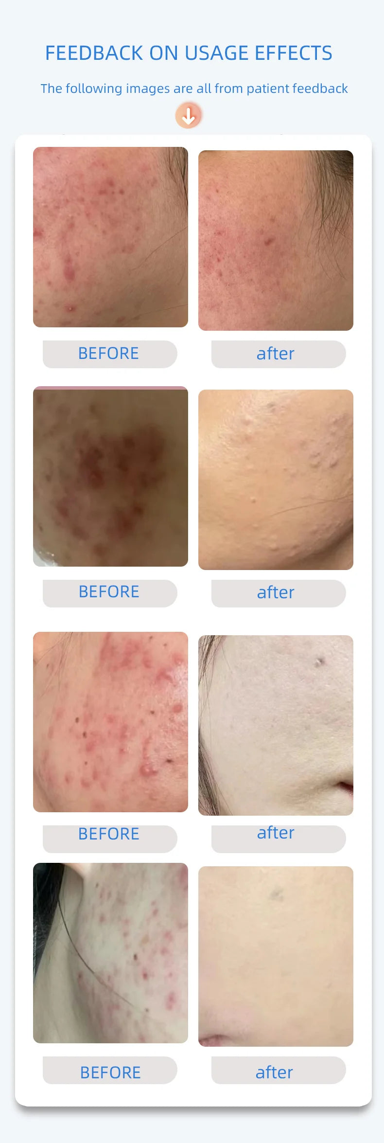 Home Use Psoriasis Equipment 308nm UV Lamps Phototherapy Medical Device UvbTreatment Light For Vitiligo