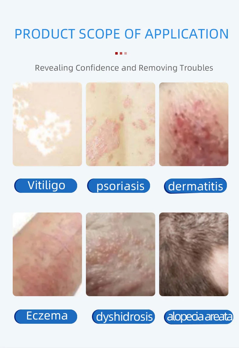 Home Use Psoriasis Equipment 308nm UV Lamps Phototherapy Medical Device UvbTreatment Light For Vitiligo