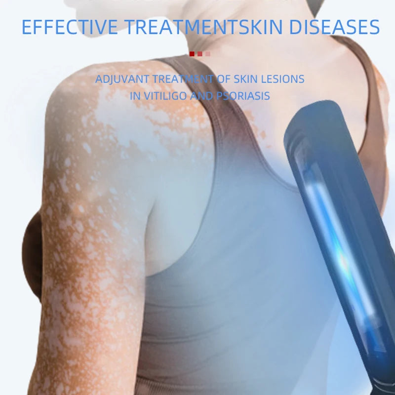 Home Use Psoriasis Equipment 308nm UV Lamps Phototherapy Medical Device UvbTreatment Light For Vitiligo